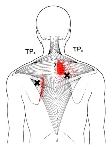 illustratie_2_triggerpoint-net.jpg